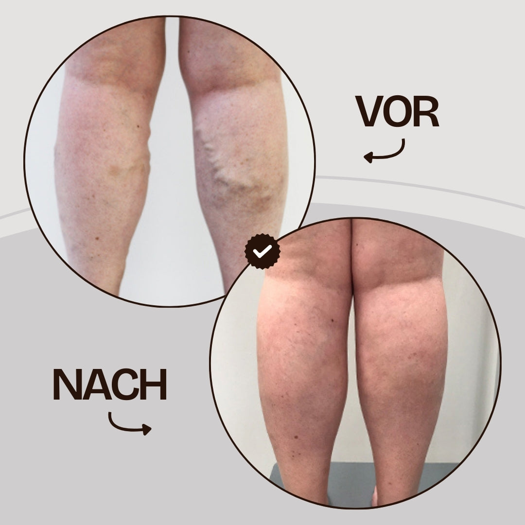 Kompressionsstrümpfe zur Linderung von Krampfadern